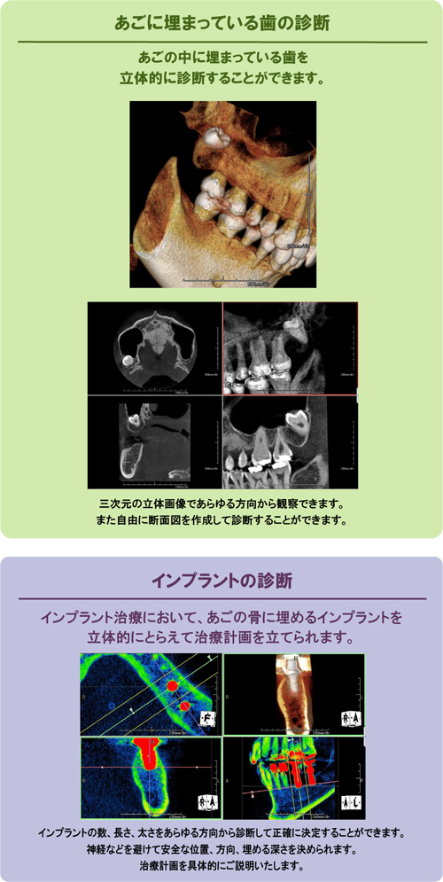 あなたの口腔内を3D画像で分析・診断 歯科用CTスキャナーのご案内 Finecube アーム型X線CT診断装置 ファインキューブ