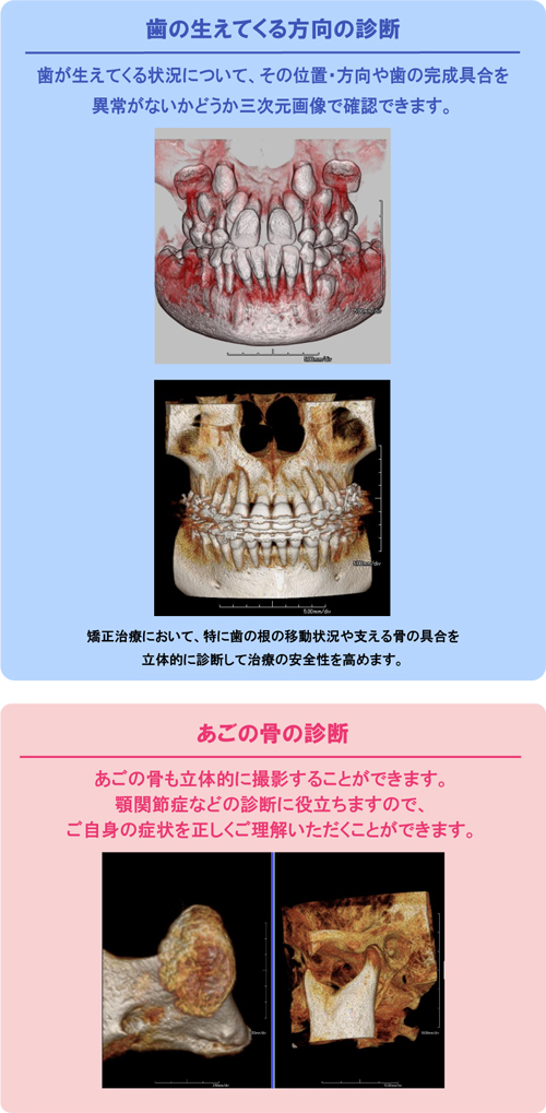 あなたの口腔内を3D画像で分析・診断 歯科用CTスキャナーのご案内 Finecube アーム型X線CT診断装置 ファインキューブ